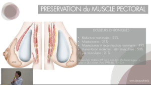 Cancer du sein - D. JB. Olivier