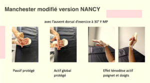 Tendons fléchisseurs de la main - F. Dap et L. Giessinger